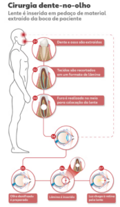 cirurgia dente no olho