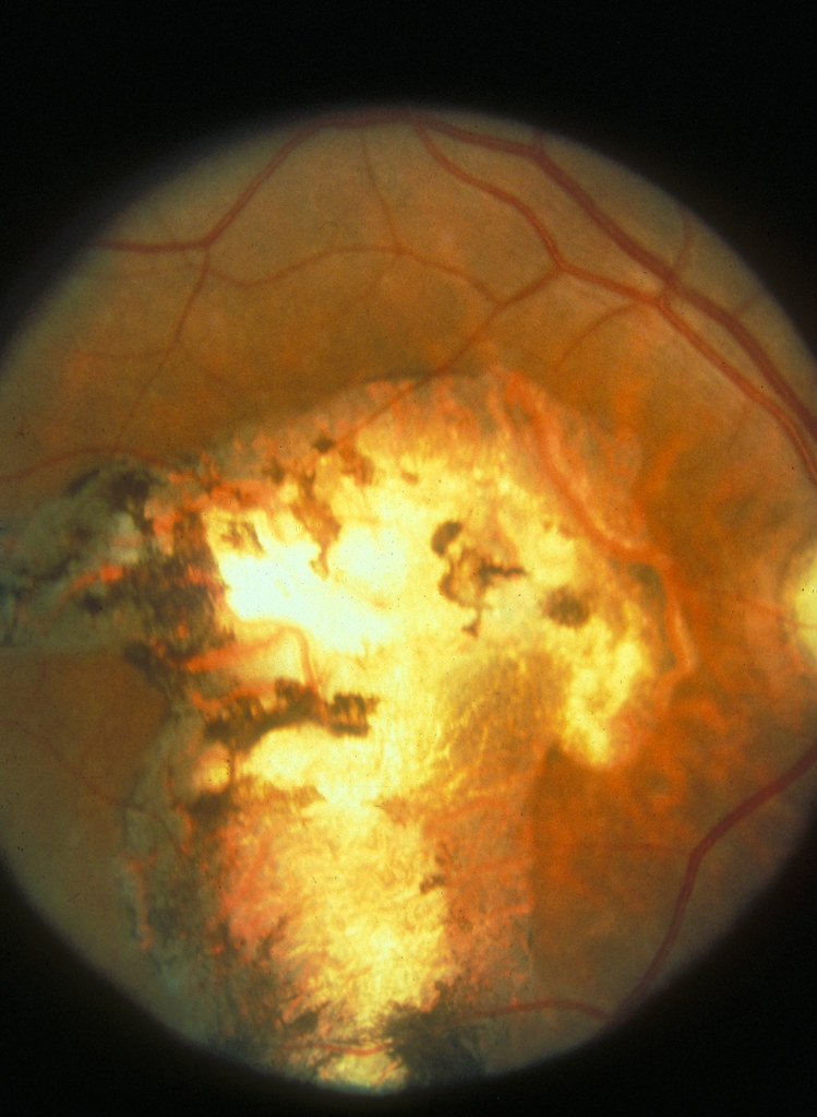 Cicatriz de retinocoroidite por toxoplasmose