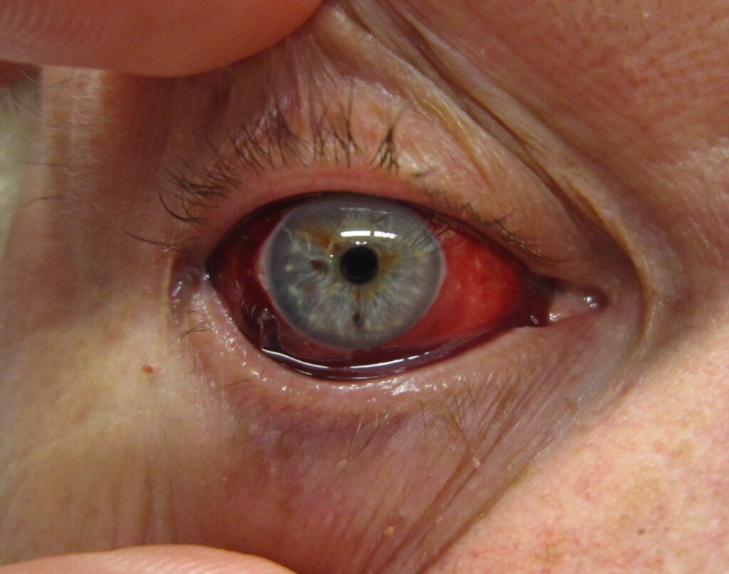 Olho com Hemorragia subconjuntival ou Olho Sangrando