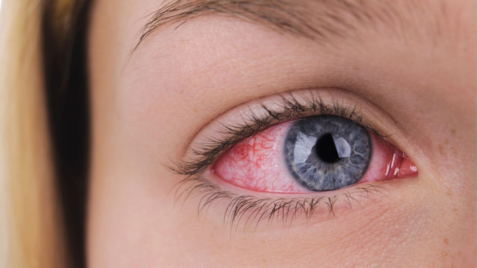 9 Causas Comuns de Olho Vermelho e Irritabilidade
