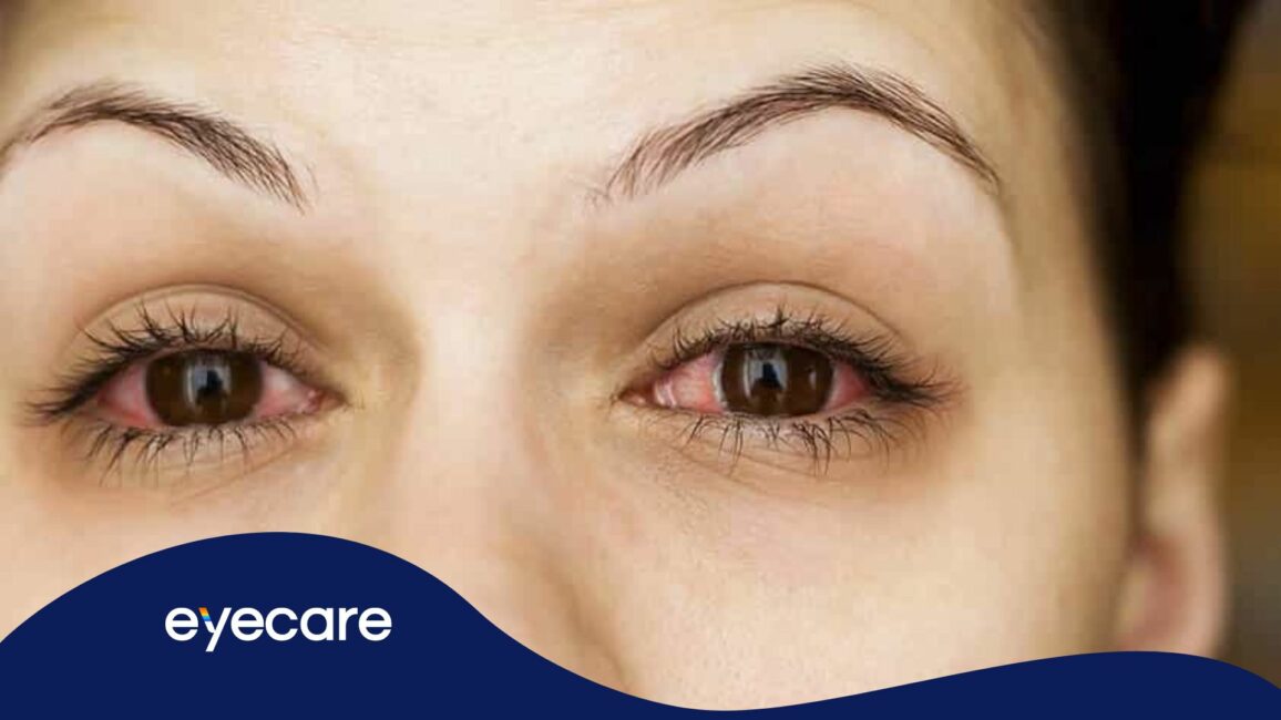 O que causa conjuntivite viral? Confira 8 vilões + tratamento!