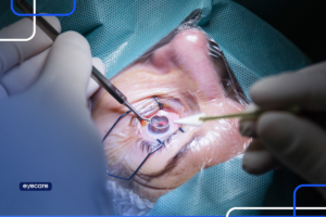 Córnea artificial: inovação no tratamento de doenças oculares.