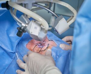 Cirurgia de Pterígio: procedimento, recuperação e resultados