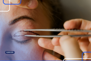 blefaroplastia