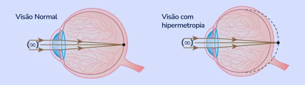 Hipermetropia Tratamento