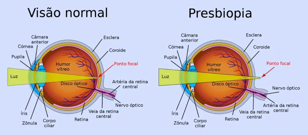 Comparação entre Visão Normal e Presbiopia Entenda as Diferenças