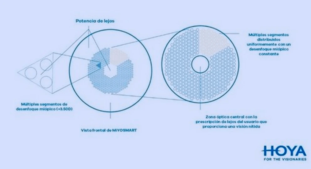 Tecnologia DIMS nas Lentes MiYOSMART Segmentos de Desfocalização para Reduzir a Progressão da Miopia