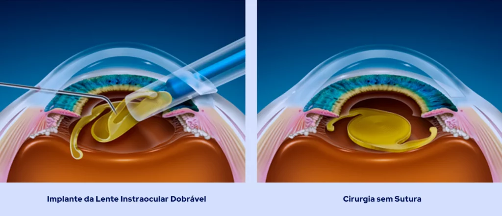 Etapas da Cirurgia de Catarata Implante de LIO Dobrável e Técnica sem Sutura