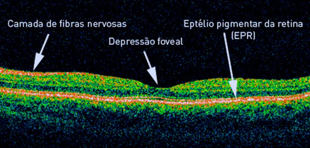 Imagem Detalhada da Retina Gerada por Tomografia de Coerência Óptica (OCT)