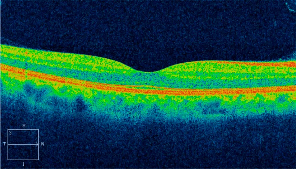 Visualização das Camadas da Retina por OCT para Diagnóstico Oftalmológico Preciso