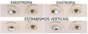 Tipos de estrabismo para a cirurgia de estrabismo