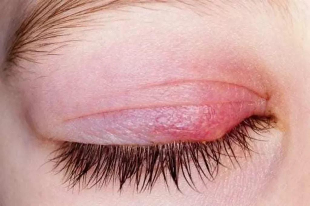 Imagem de pálpebra com inflamação causada por terçol, ilustrando sintomas visuais comuns relacionados aos tratamentos para terçol