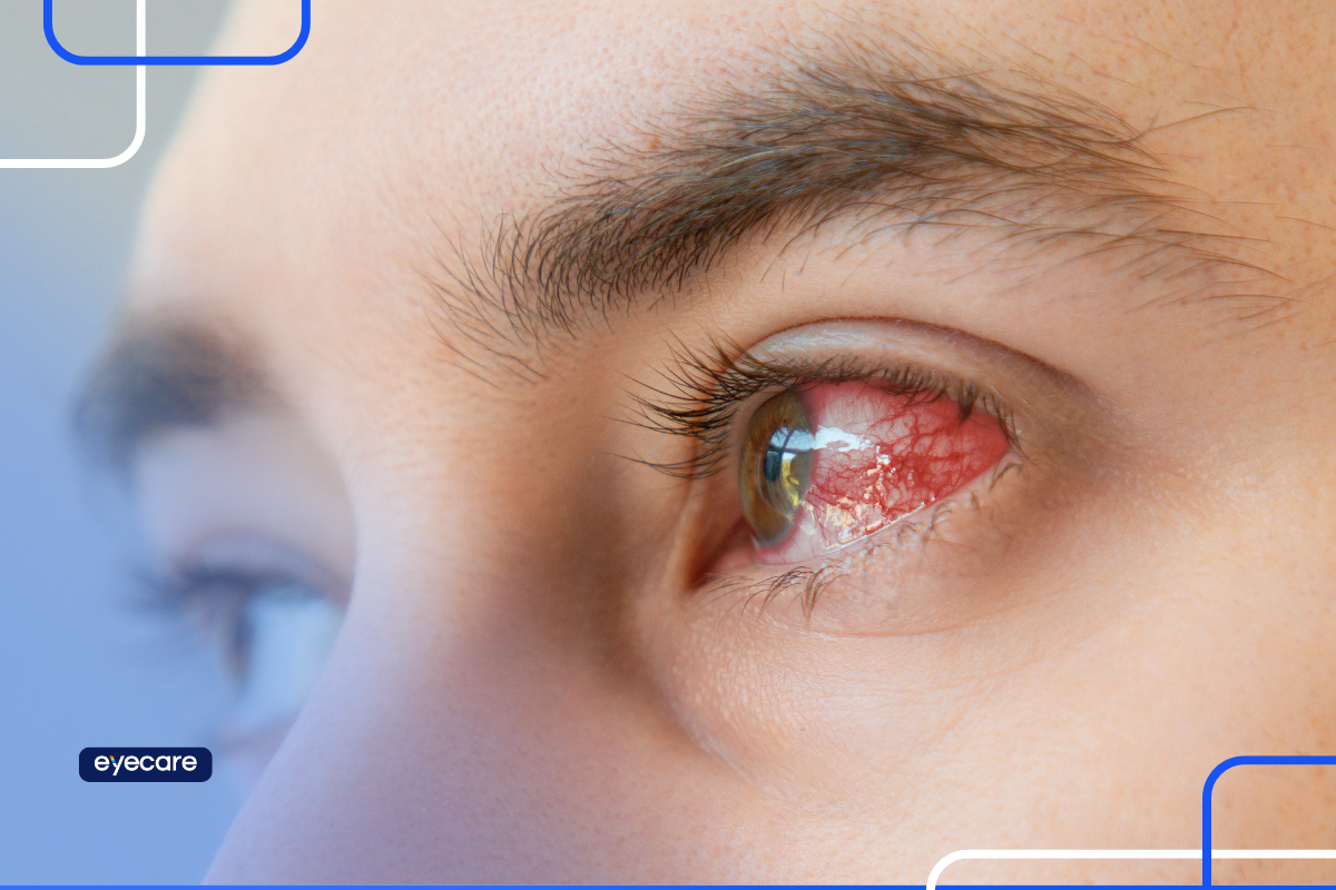 Você sabe o que é ceratite? Leia o artigo da Eyecare Health