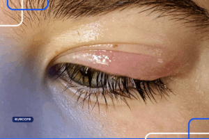 Pálpebra inchada em close, mostrando sinais de inflamação ocular