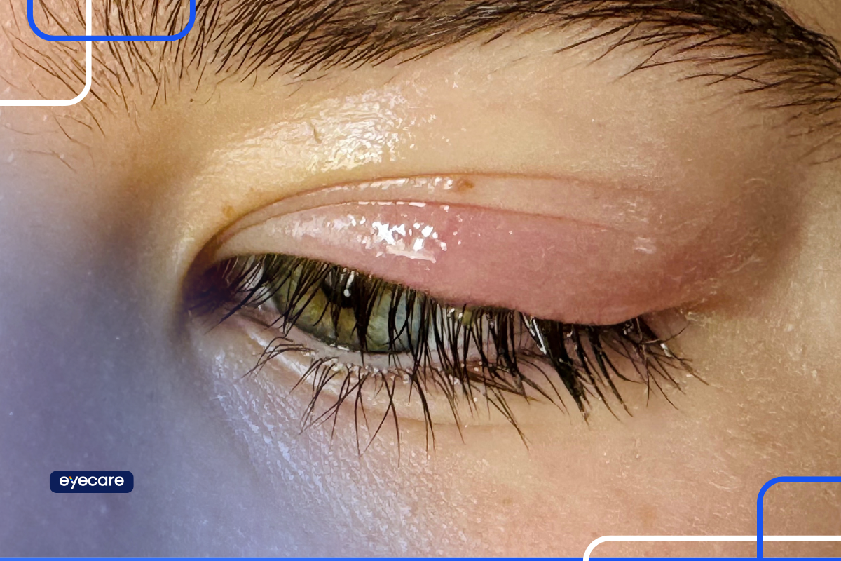 Pálpebra inchada em close, mostrando sinais de inflamação ocular