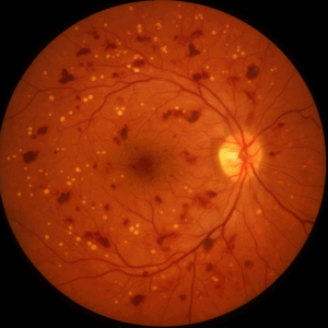 retinopatia diabética