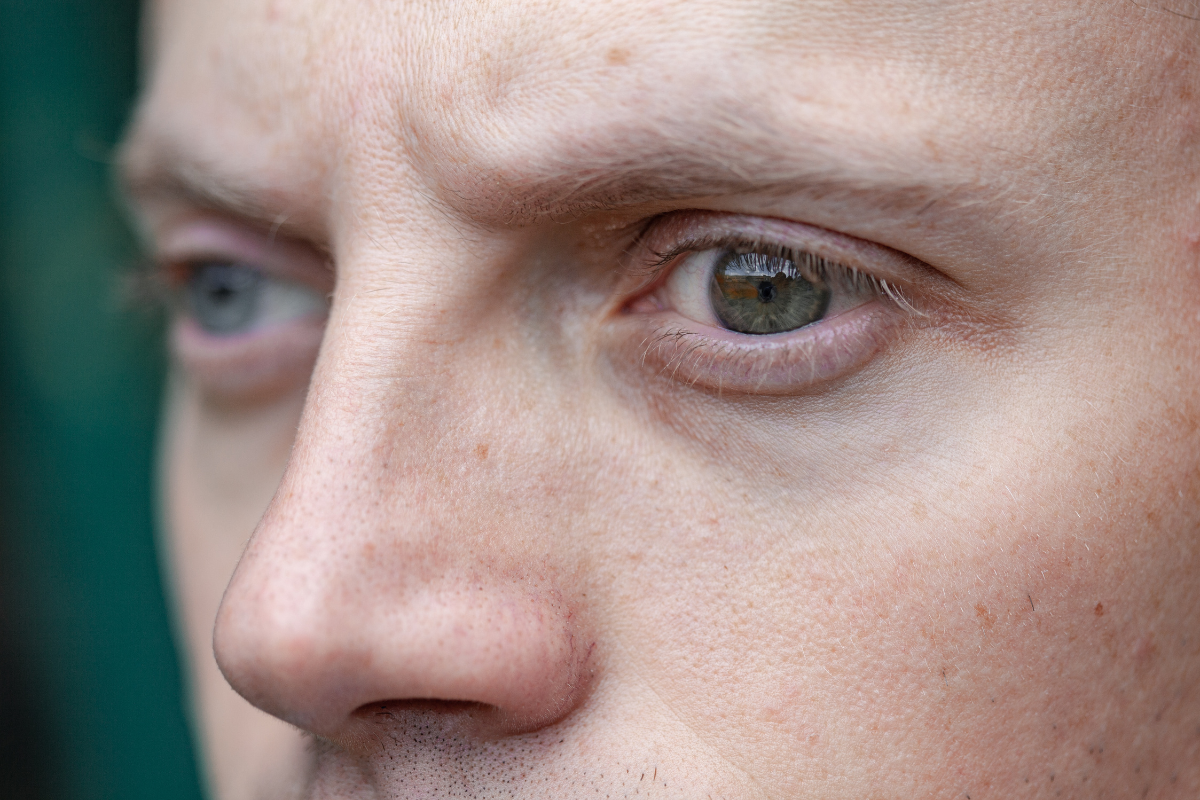 CID-10 H49 – Estrabismo Paralítico