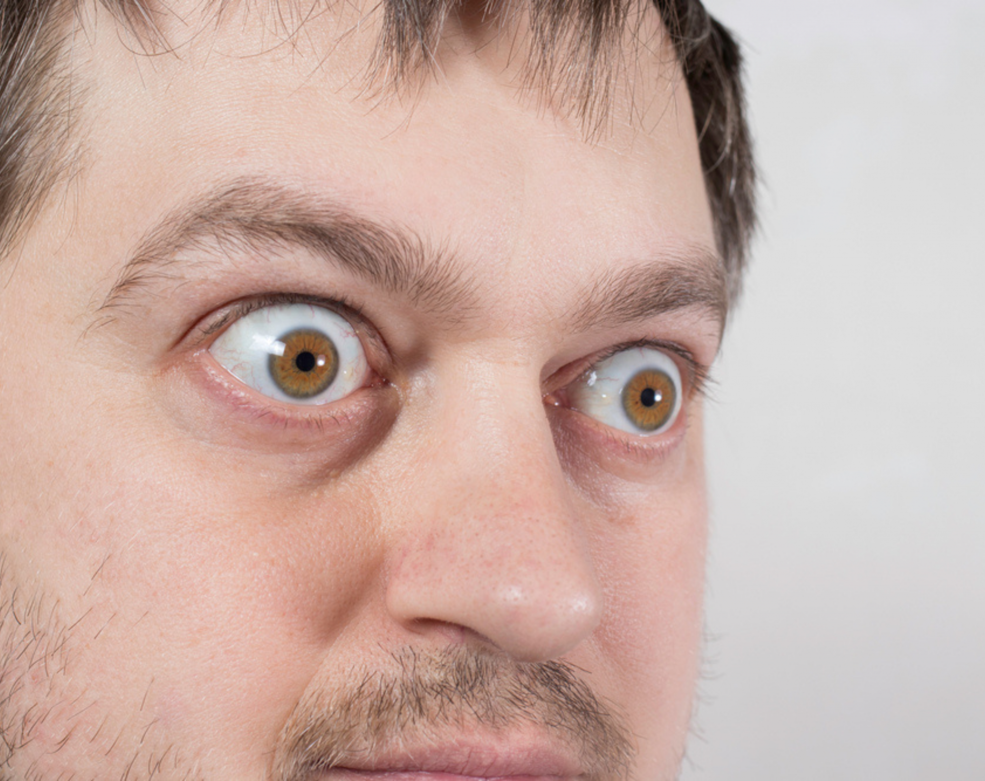 homem com os olhos esbugalhados devido a exoftalmia orig 1 - Blog