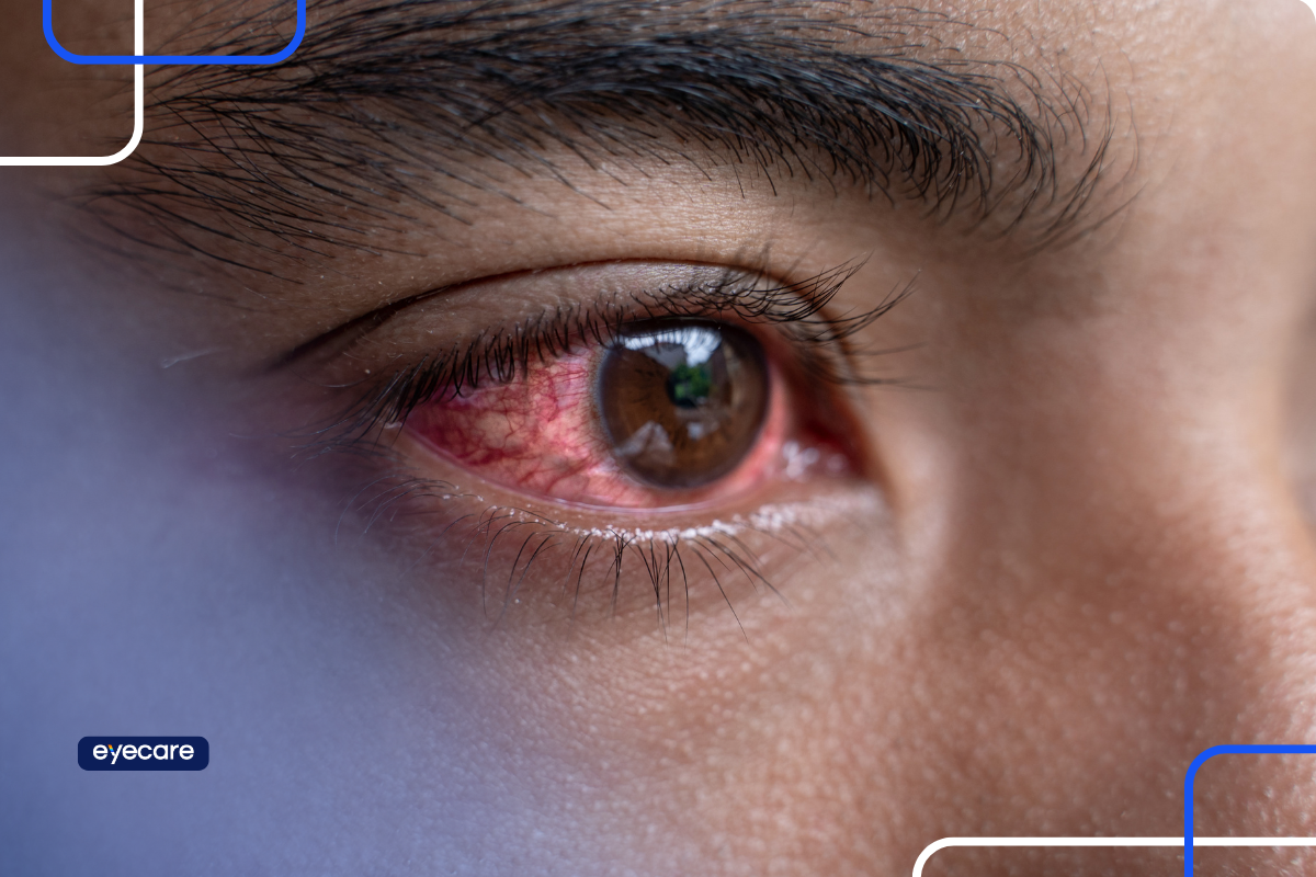 Infecção nos Olhos