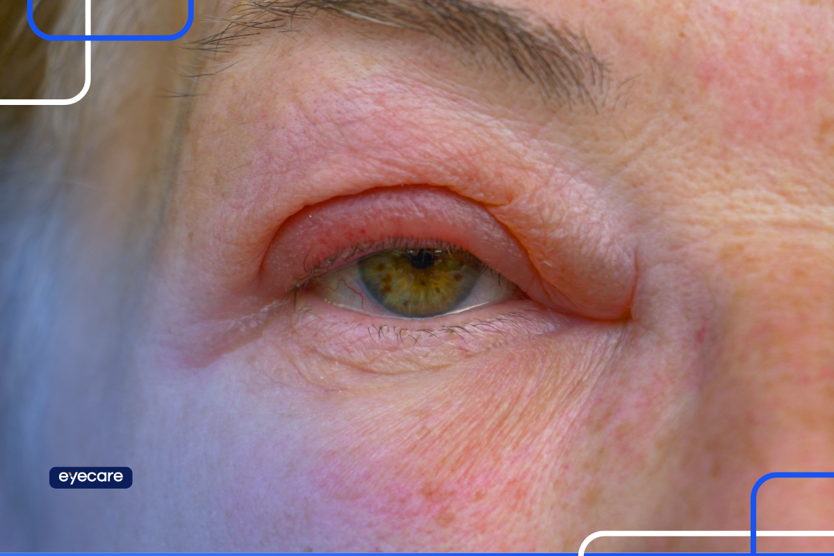 Celulite no olho: o que é, sintomas e tratamento | Eyecare Health
