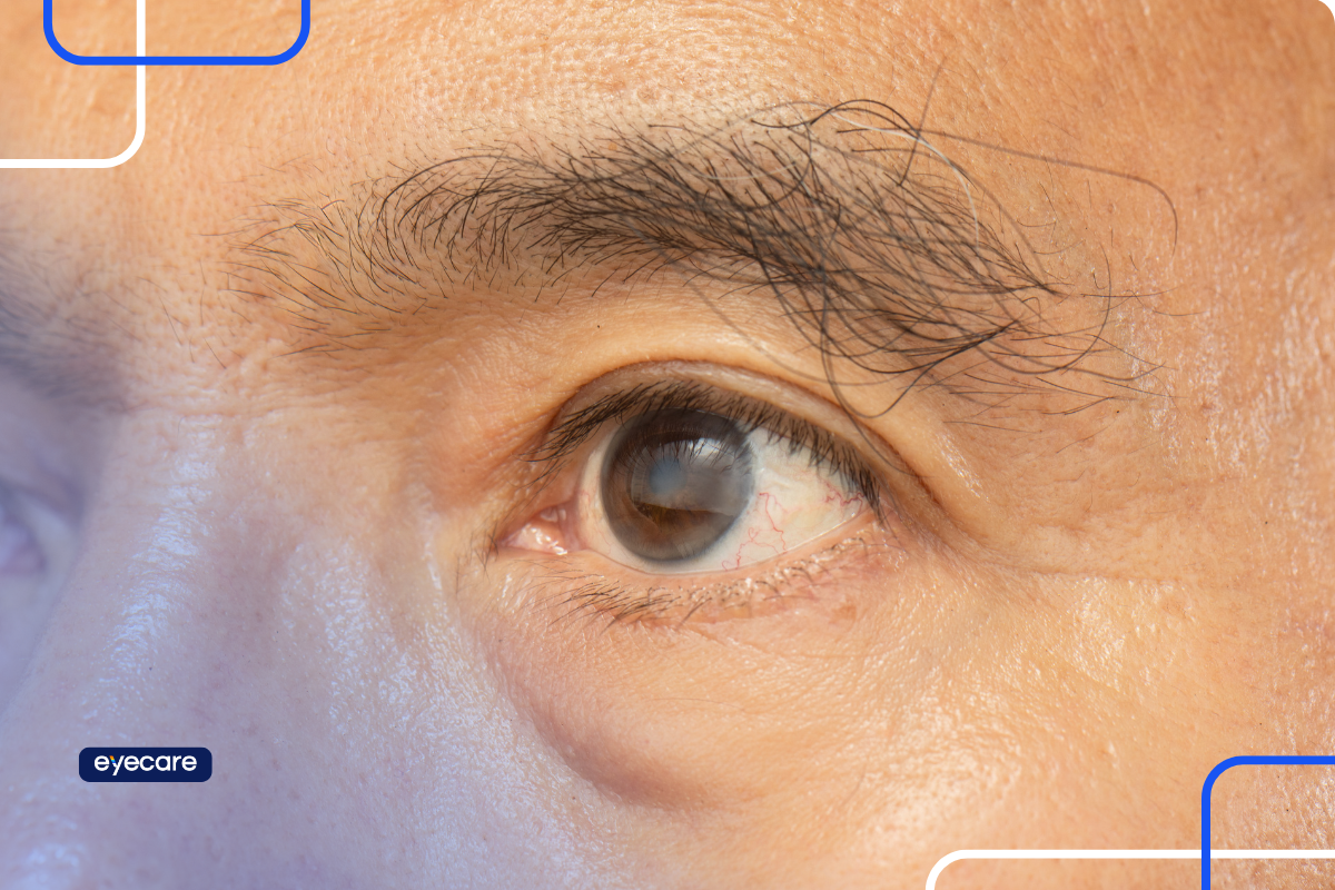 Especialista em catarata realizando avaliação oftalmológica em paciente